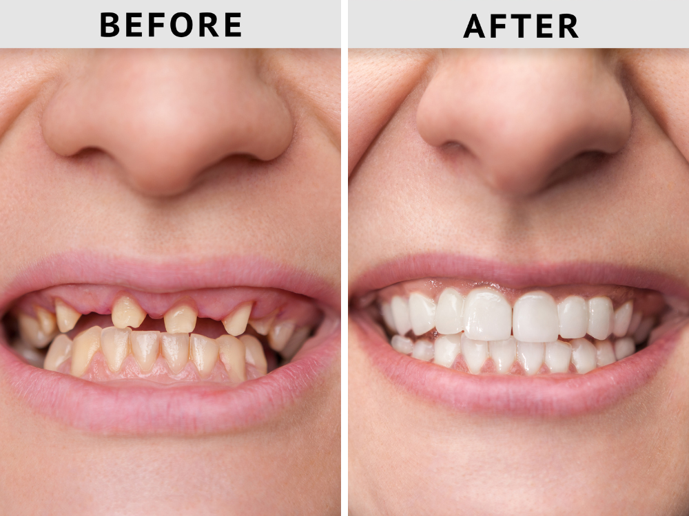 Before and after results of dental crown treatment