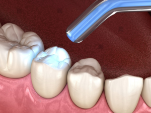 Blue curing light used to harden a dental filling
