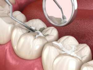 Close-up of cavity treatment during a dental filling procedure