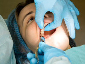 Dr. Sarah LeClere of East Indy Dental Care extracting a tooth from a patient during a dental procedure Dr. Sarah LeClere of East Indy Dental Care extracting a tooth from a patient during a dental procedure